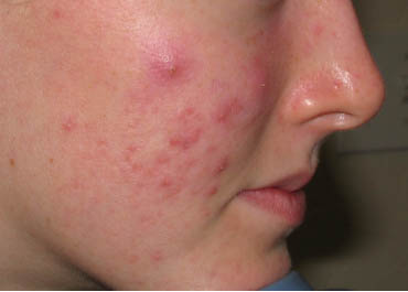 medication for acne