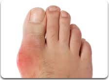 gout diet