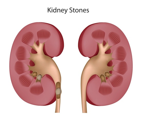 kidney stones